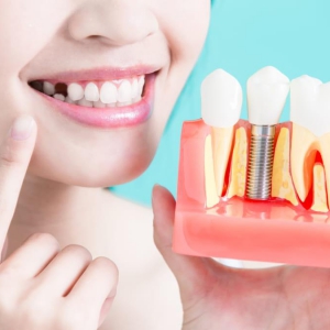 Trồng Răng Implant Uy Tín Tại Đà Nẵng - Ưu Đãi 30% - Tặng Răng Sứ Cao Cấp