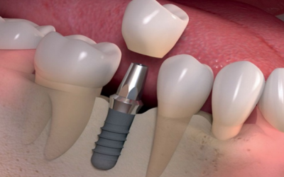 Trồng Răng Implant Tại Đà Nẵng - Đến Ngay Nha Khoa Sài Gòn Quốc Tế