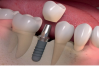 Trồng Răng Implant Tại Đà Nẵng - Đến Ngay Nha Khoa Sài Gòn Quốc Tế