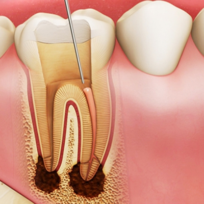 ĐIỀU TRỊ TỦY RĂNG KHÔNG ĐAU - CÔNG NGHỆ HIỆN ĐẠI